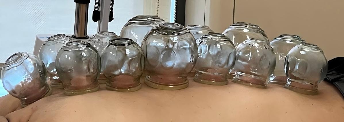 Cupping – en ældgammel behandling med moderne effekt
