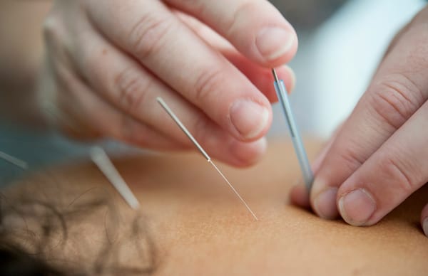 Introduktion til Akupunktur – Naturlig Balance og Heling